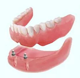 Bar Retained Denture